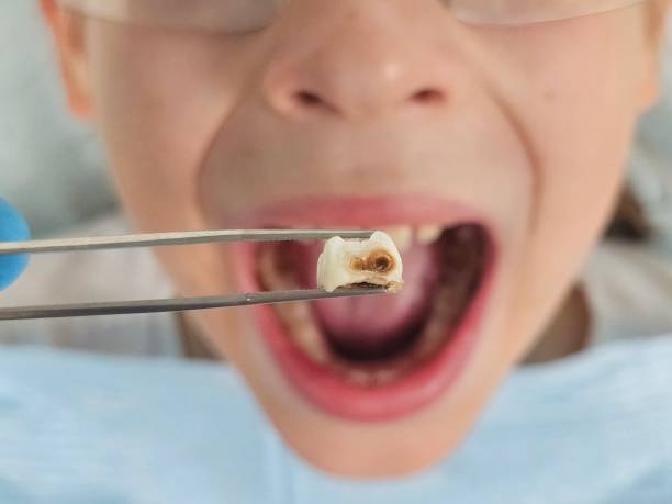Best Emergency Broken Tooth Repair in Wetumka, OK